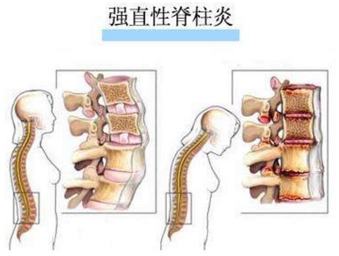 早期强直性脊柱炎的症状主要有哪些