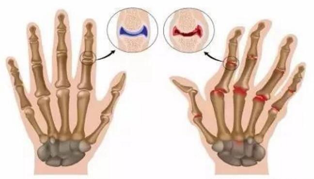 风湿关节炎与类风湿关节炎为什么不能混为一谈!