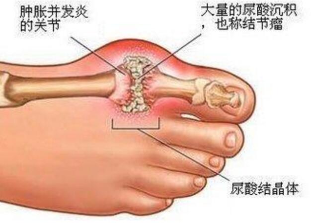 关节疼痛未必就是风湿骨病，还有可能是这种疾病！对症下药！(图4)