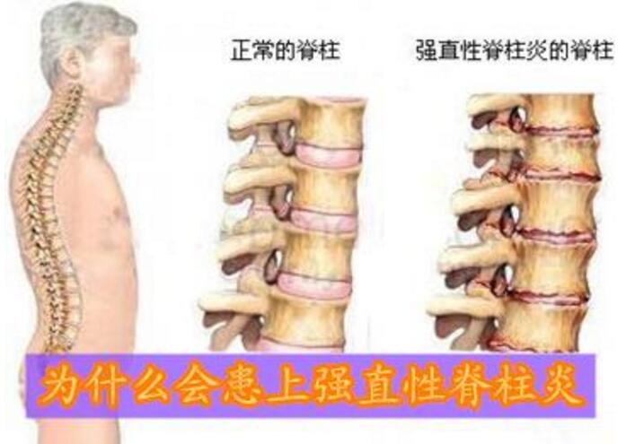 【郑州强直专科医院】强直性脊柱炎的起病原因都是什么