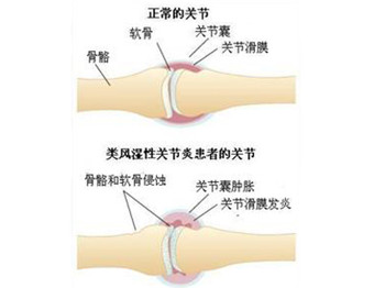 治疗类风湿有哪几个方法？