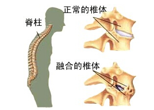 知道强直性脊柱炎这几种治疗方法，这几种方法可以有效的缓解患者疼痛