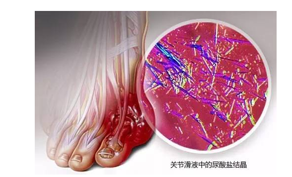 痛风关节疼痛应该如何是好？这两大治疗方法可以有效的缓解疼痛