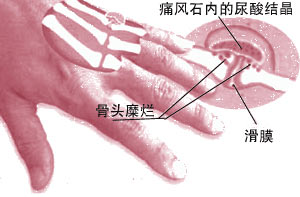 痛风突然发作了应该怎么办？教你五个小诀窍轻松应对