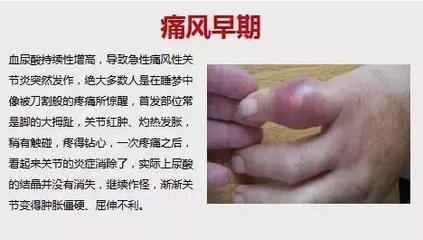 痛风性关节炎是一种什么样疾病，对此专家做出了一个相关的介绍