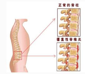 强直性脊柱炎平时饮食护理注意什么？