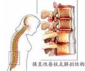 对强直性脊柱炎的饮食有帮助的蔬菜有哪些？