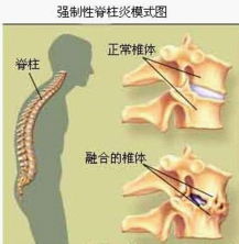 强直性脊柱炎怎样锻炼对康复健康有利