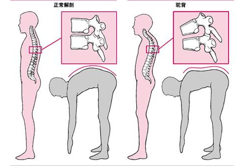 郑州强直性脊柱炎医院讲述强直性脊柱炎有生命危险吗?