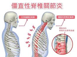 强直脊柱炎遗传几岁可以检查出来？强直性脊柱炎遗传率到底有多大(图1)